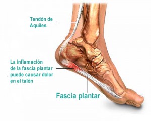 podologo segovia el espinar espolon de calcaneo