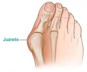 podologo segovia el espinar juanete