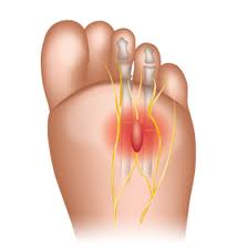 neuroma-de-morton