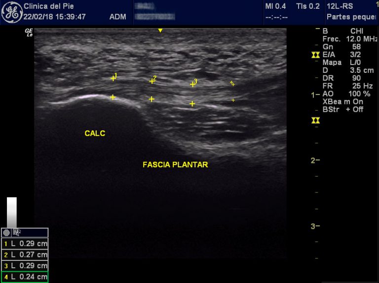 ECOGRAFÍA Clínica del Pie Segovia